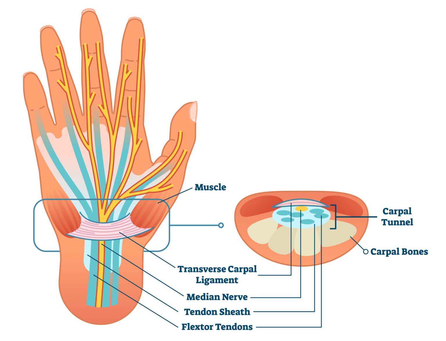 What is Endoscopic Carpal Tunnel Surgery?