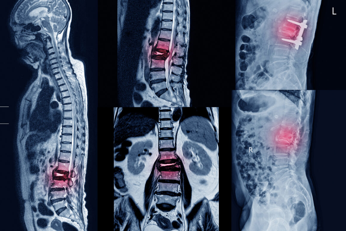 What Is Spinal Fusion Surgery?