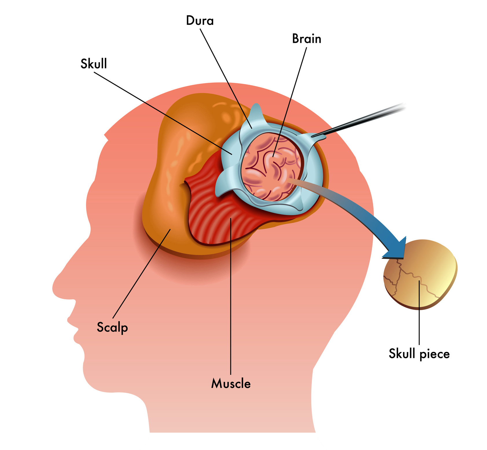 what-is-an-awake-craniotomy