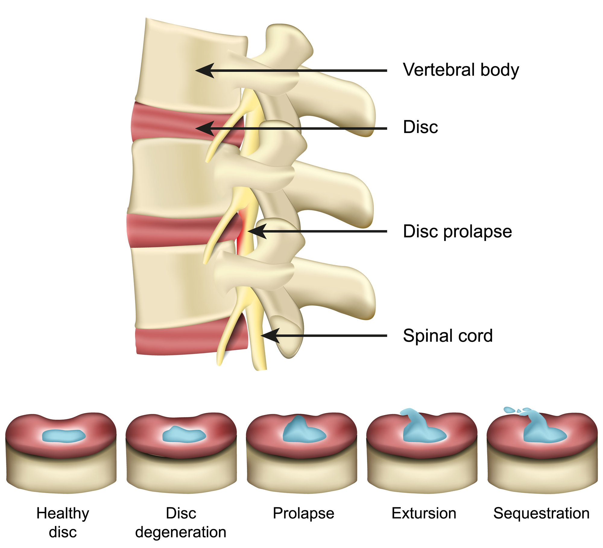 Cervical, Lumbar and Thoracic Disc Herniation
