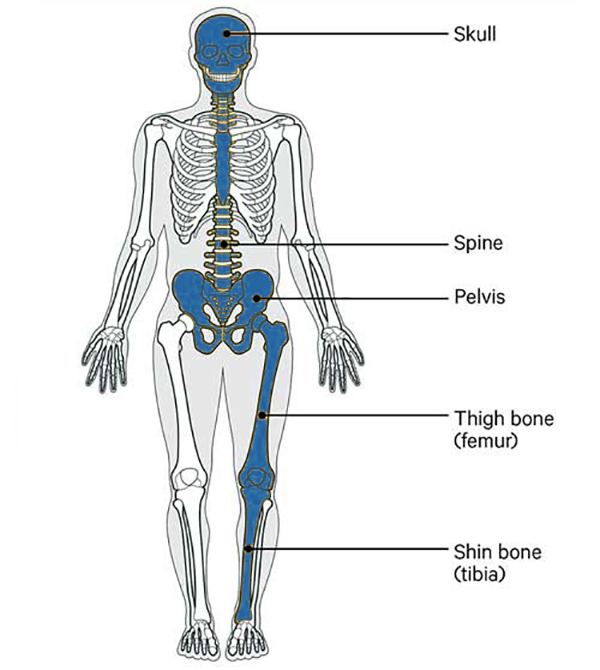 How Paget’s Disease Affects Bones in the Body