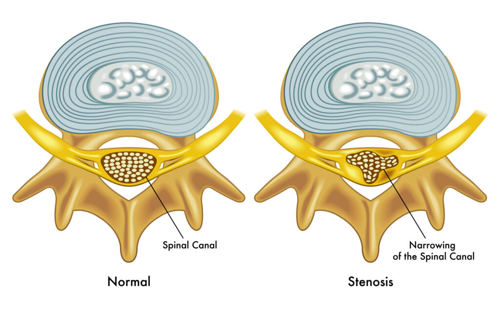 What Is Spinal Stenosis?